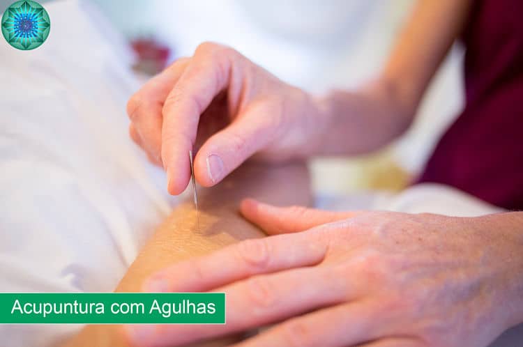 agulha de acupuntura em costas 